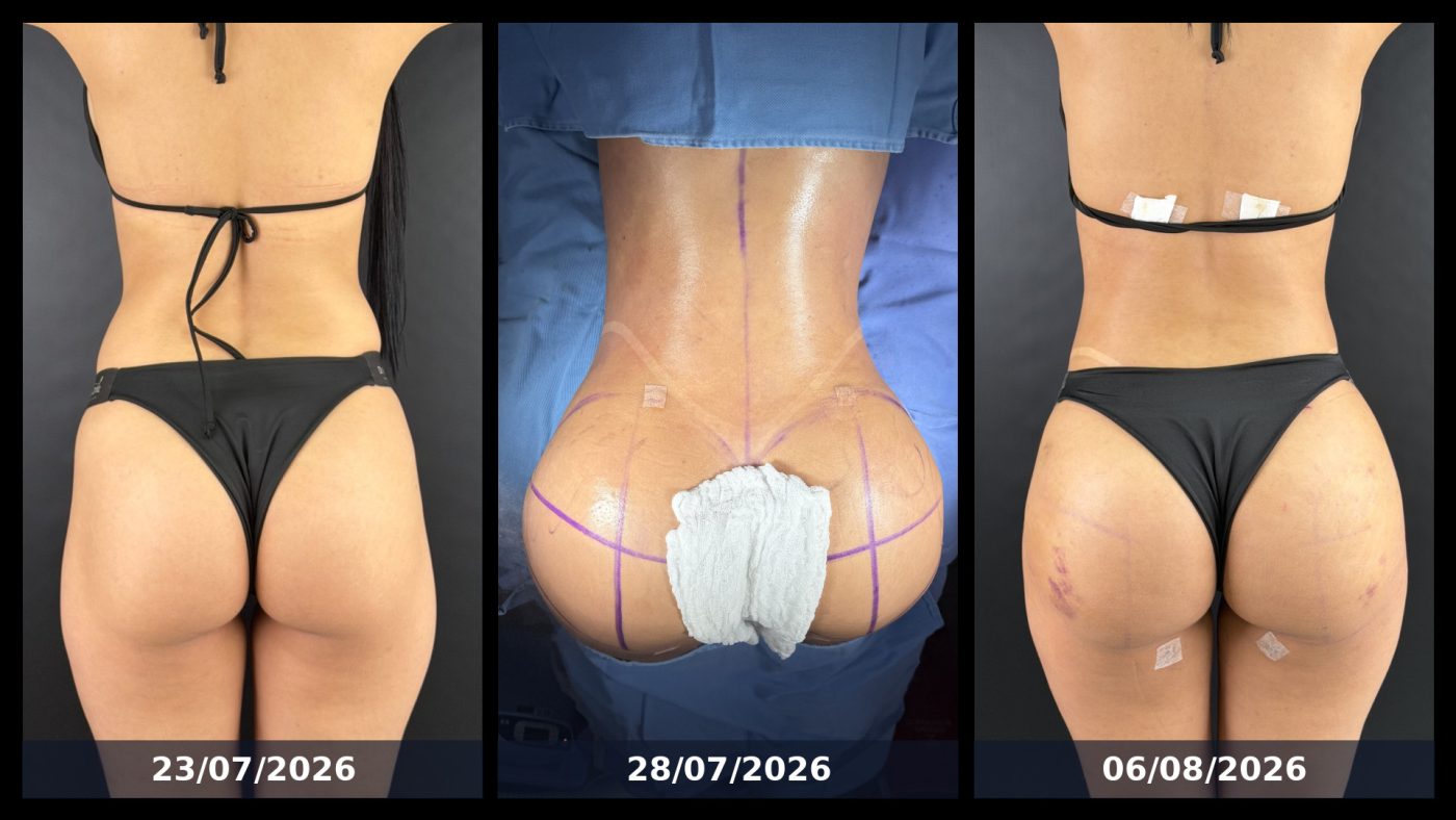Resultado de lipoescultura + transferencia glutea