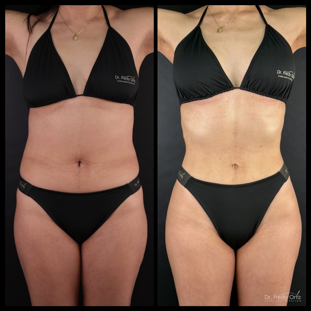 Resultado de lipoescultura