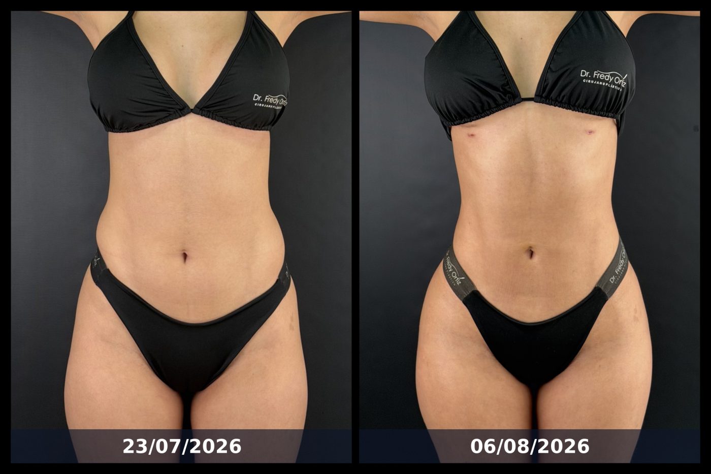 Resultado de lipoescultura con tecnología de ultrasonido y vibroliposucción