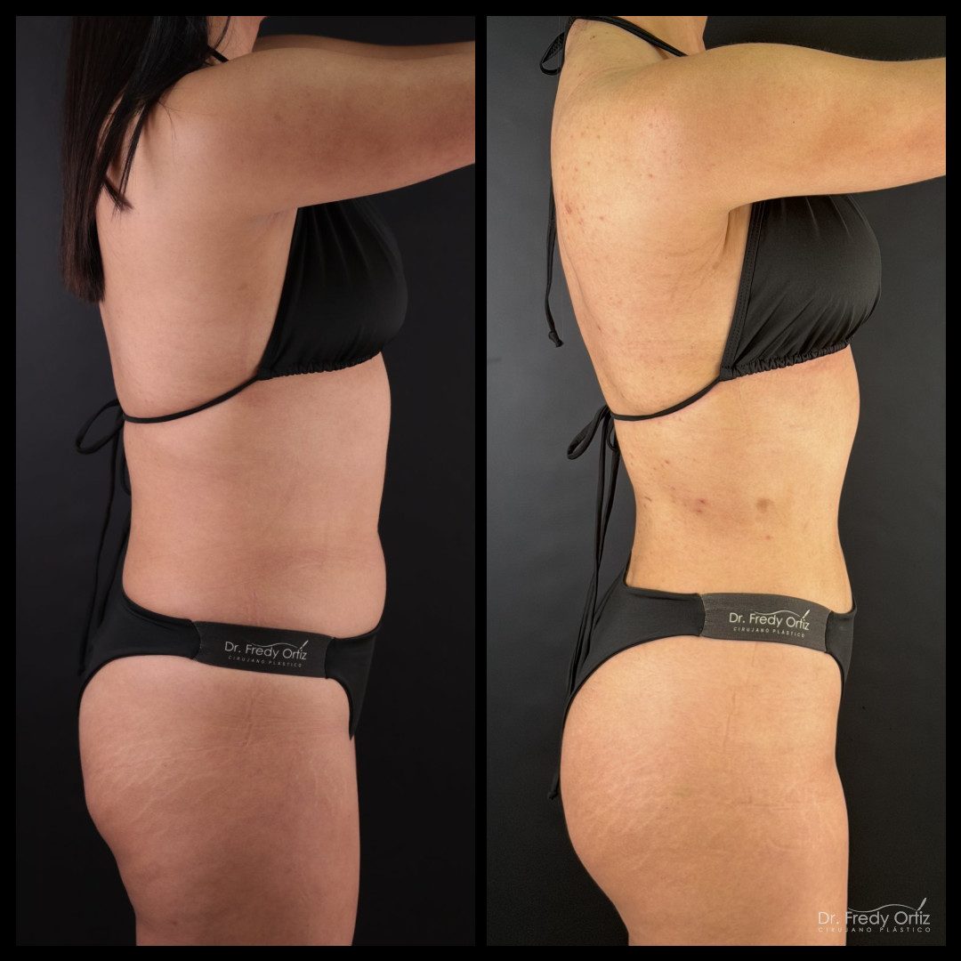Resultado de lipoescultura